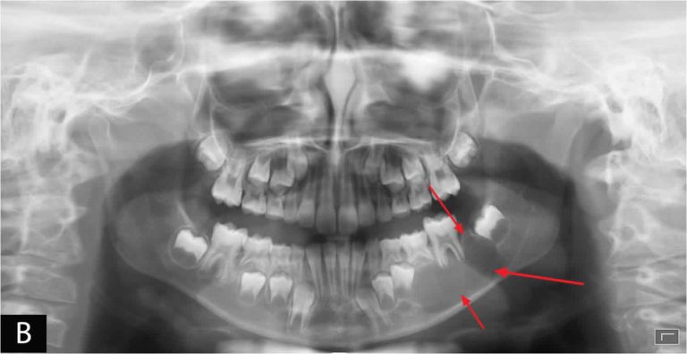 Aneurysmal Bone Cyst Causes Symptoms Diagnosis Treatment Recurrence And Prognosis 2310