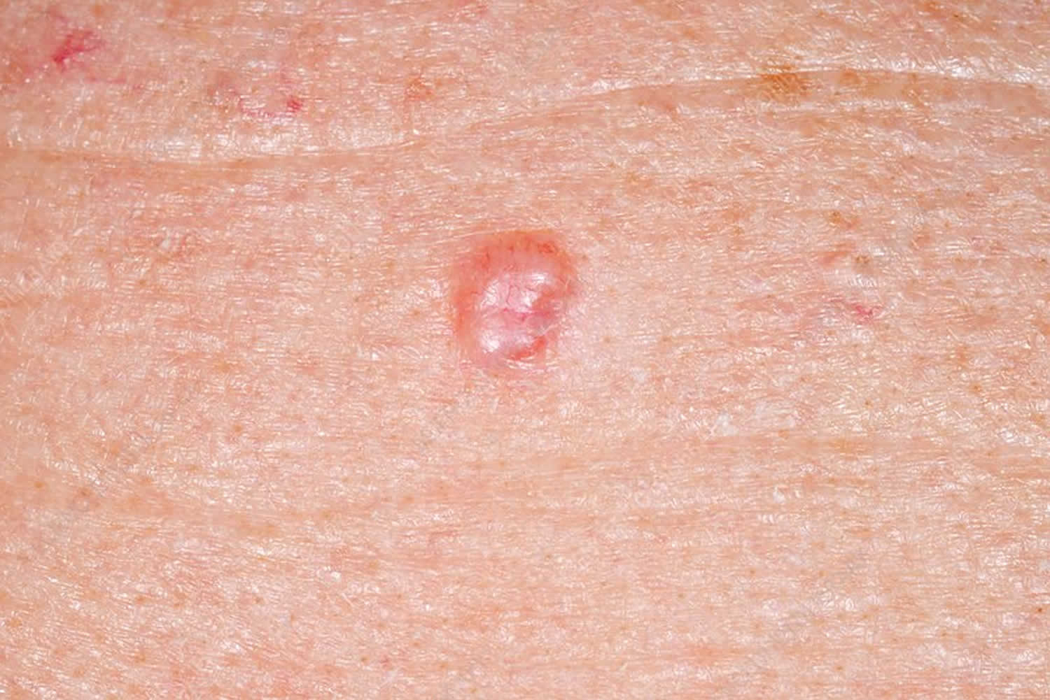 Basal cell carcinoma in children