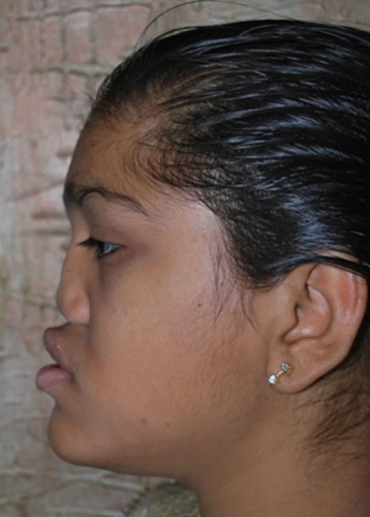 Binder syndrome causes, symptoms, diagnosis, treatment & prognosis