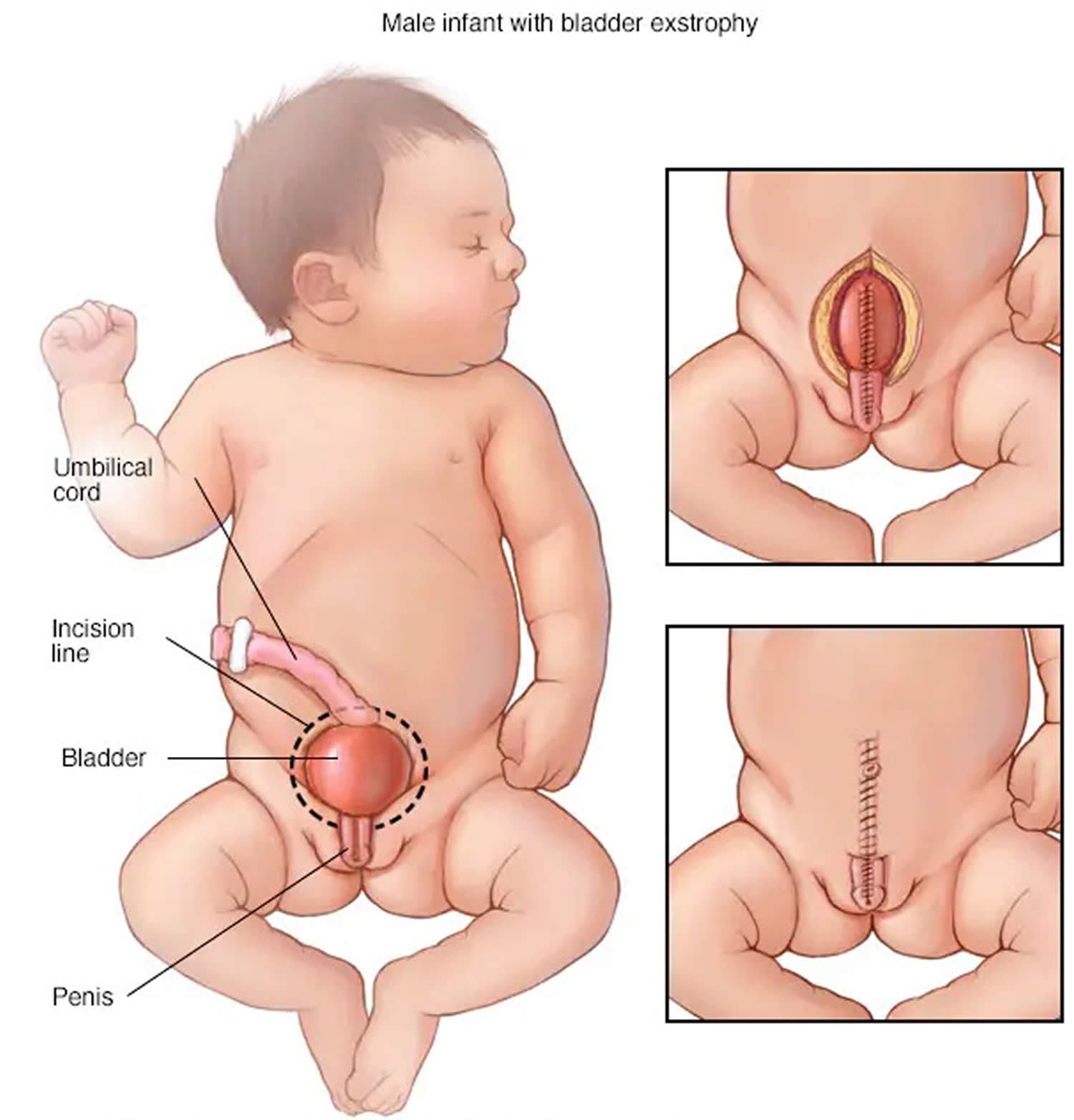 Cloacal bladder exstrophy male infant
