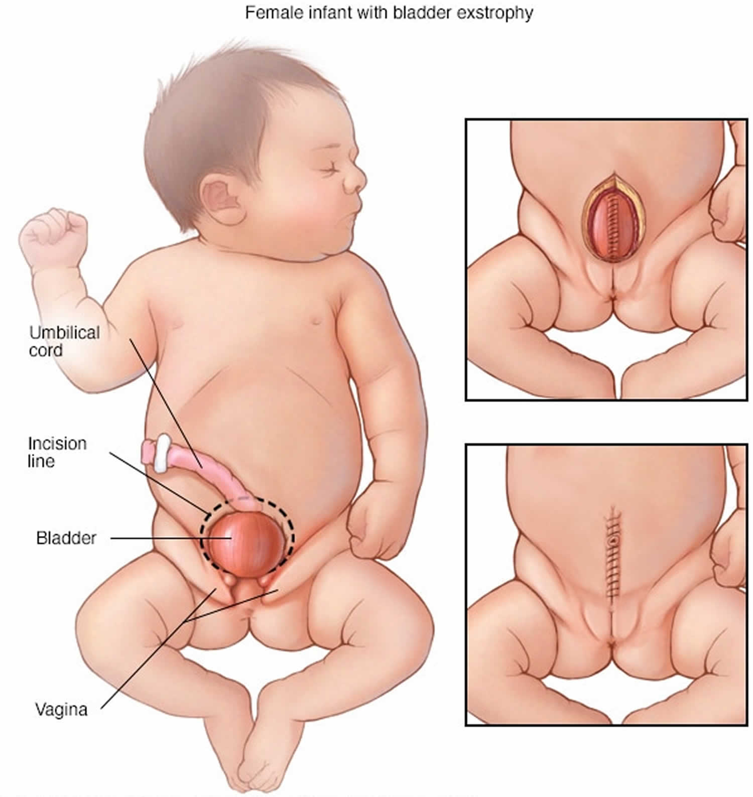 cloacal bladder exstrophy female infant