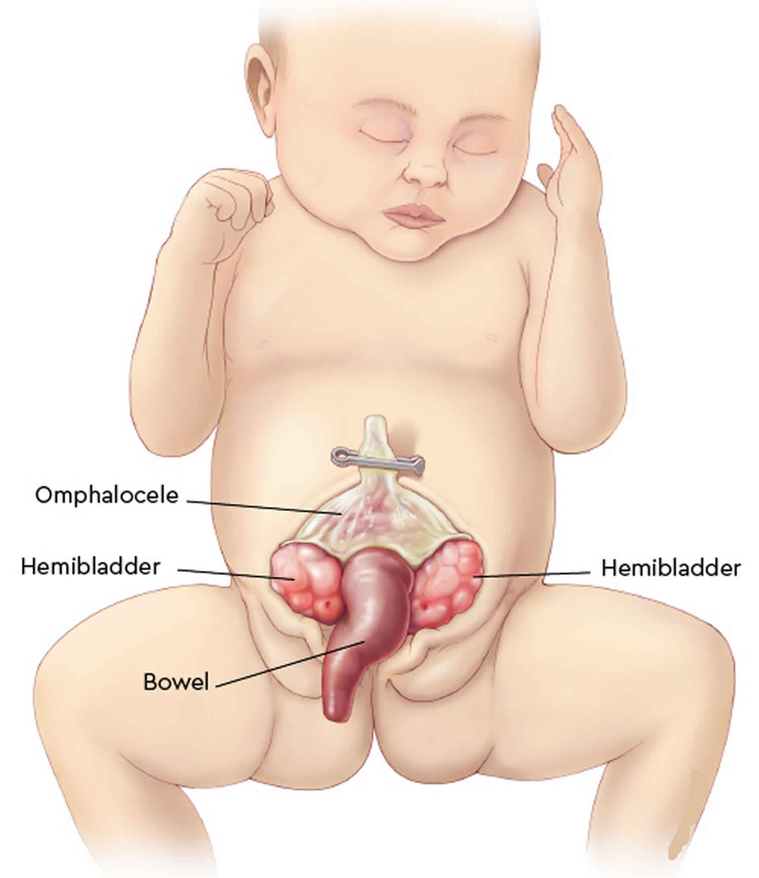 Omphalocele as component of multiple anomaly syndrome/sequence