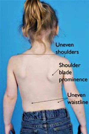 Congenital scoliosis