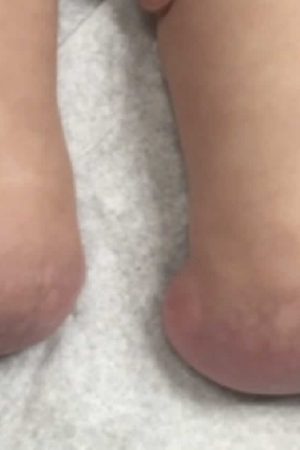 Congenital vertical talus