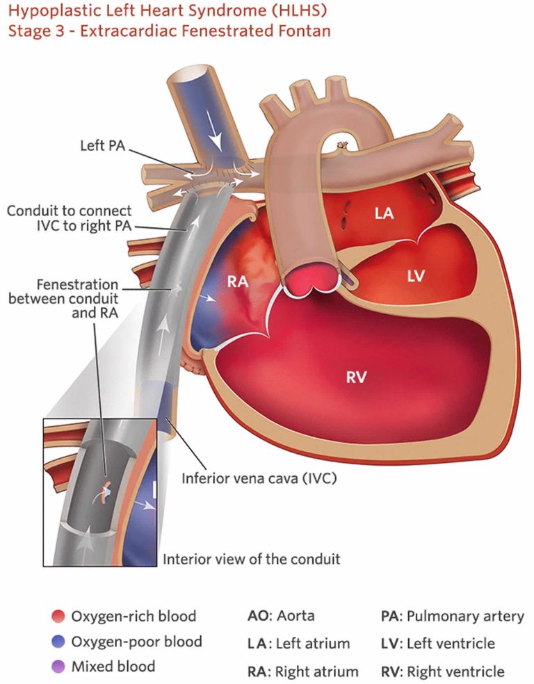 Fontan procedure, uses, types, recovery & complications