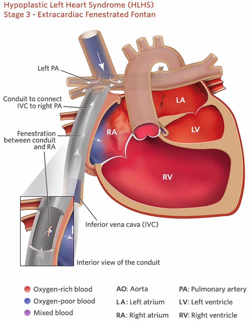 Fontan procedure, uses, types, recovery & complications