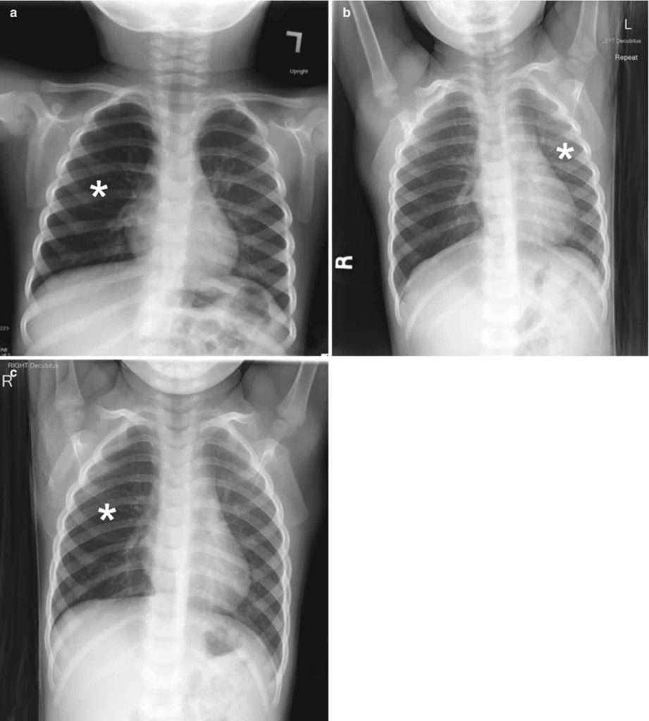 Foreign Body Aspiration Causes Symptoms Diagnosis Treatment And Prognosis 2931