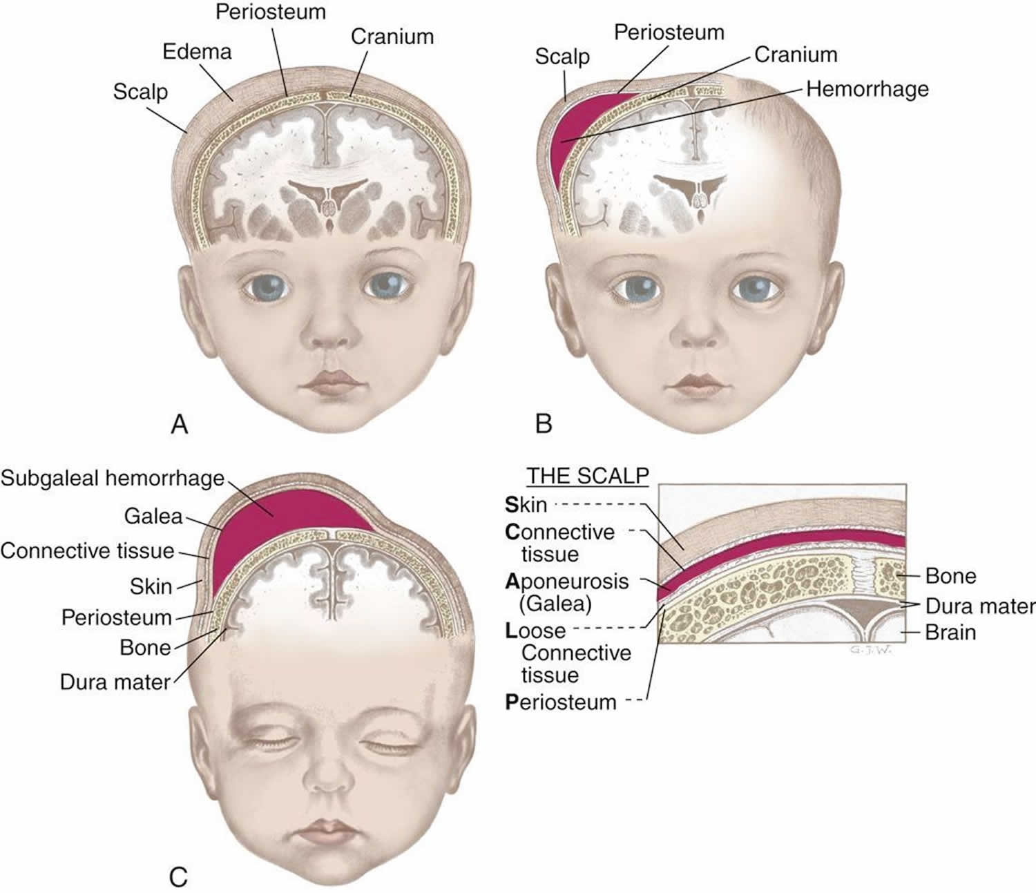 Birth Injuries Causes, Signs, Symptoms, Diagnosis, Treatment & Prognosis