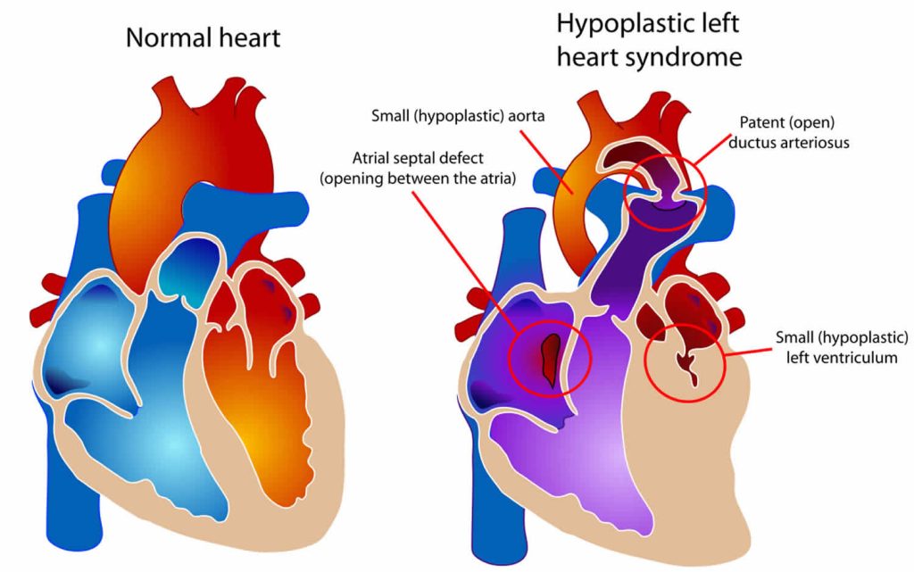 Fontan procedure, uses, types, recovery & complications