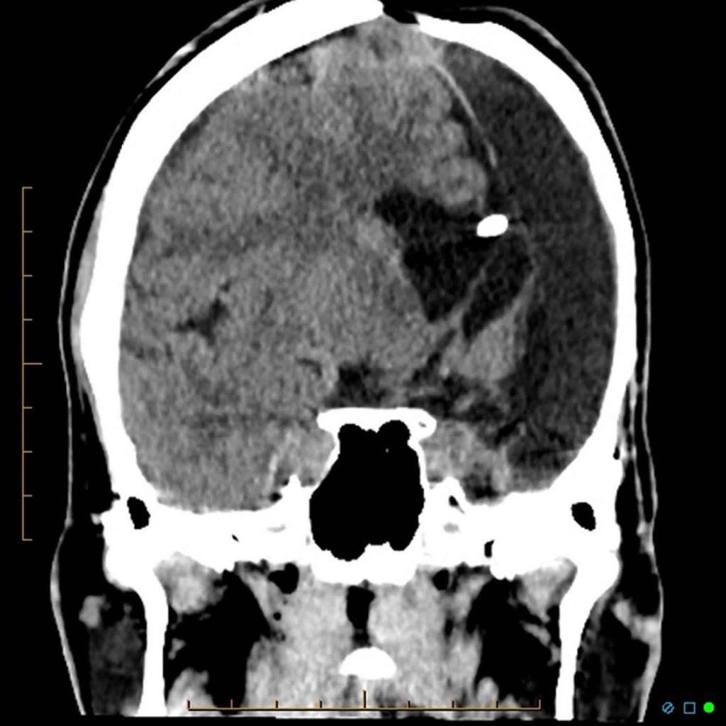 Hemispherectomy Indications Prognosis Risks Side Effects And Complications