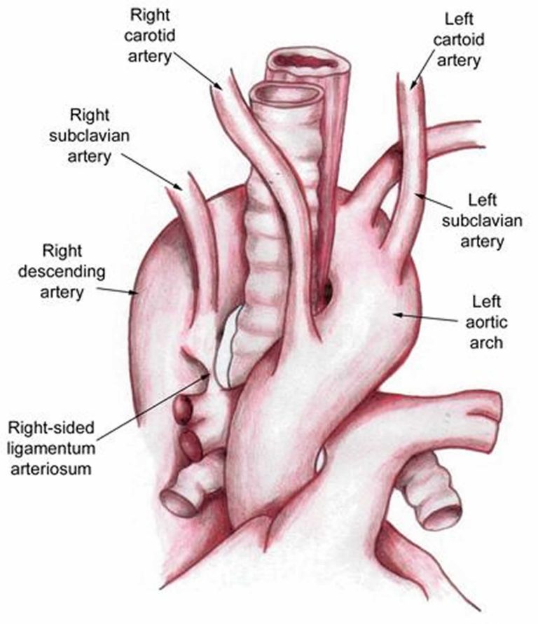 Vascular ring causes, symptoms, diagnosis, treatment & prognosis