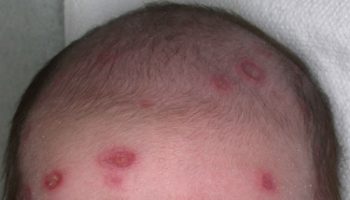 Pediatric lupus