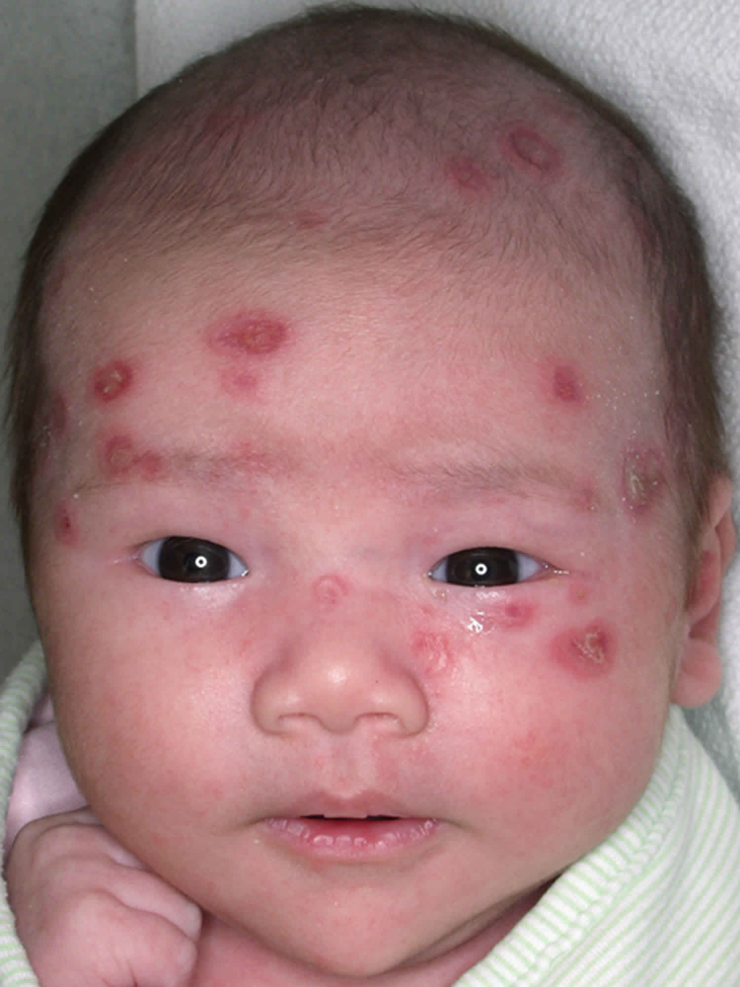 Pediatric lupus