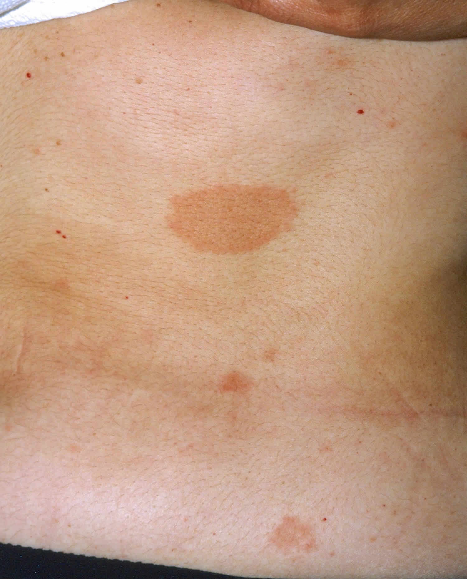 Pityriasis Rosea Condition, Treatments and Pictures for Teens - Skinsight