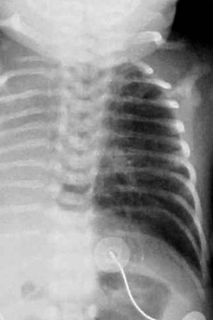 Pulmonary hypoplasia