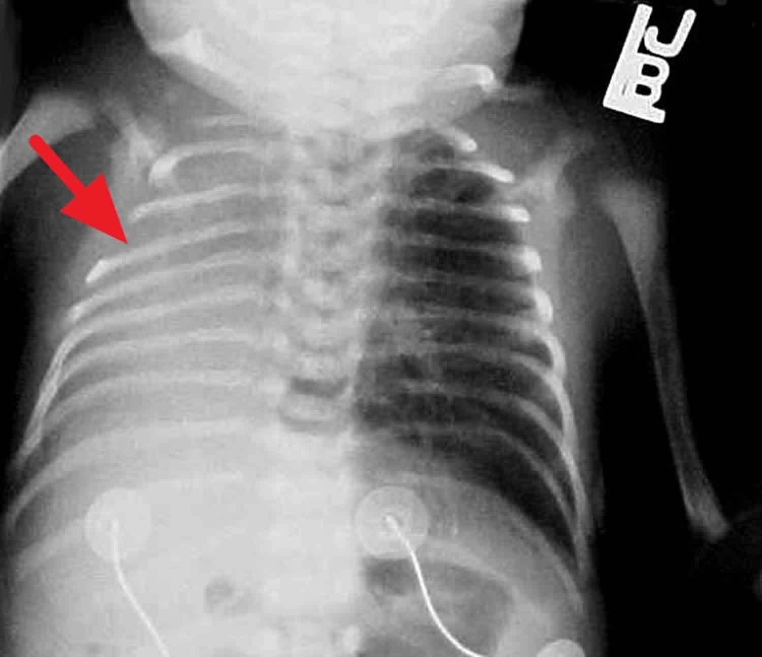 Pulmonary Hypoplasia Causes Symptoms Diagnosis Treatment Prognosis