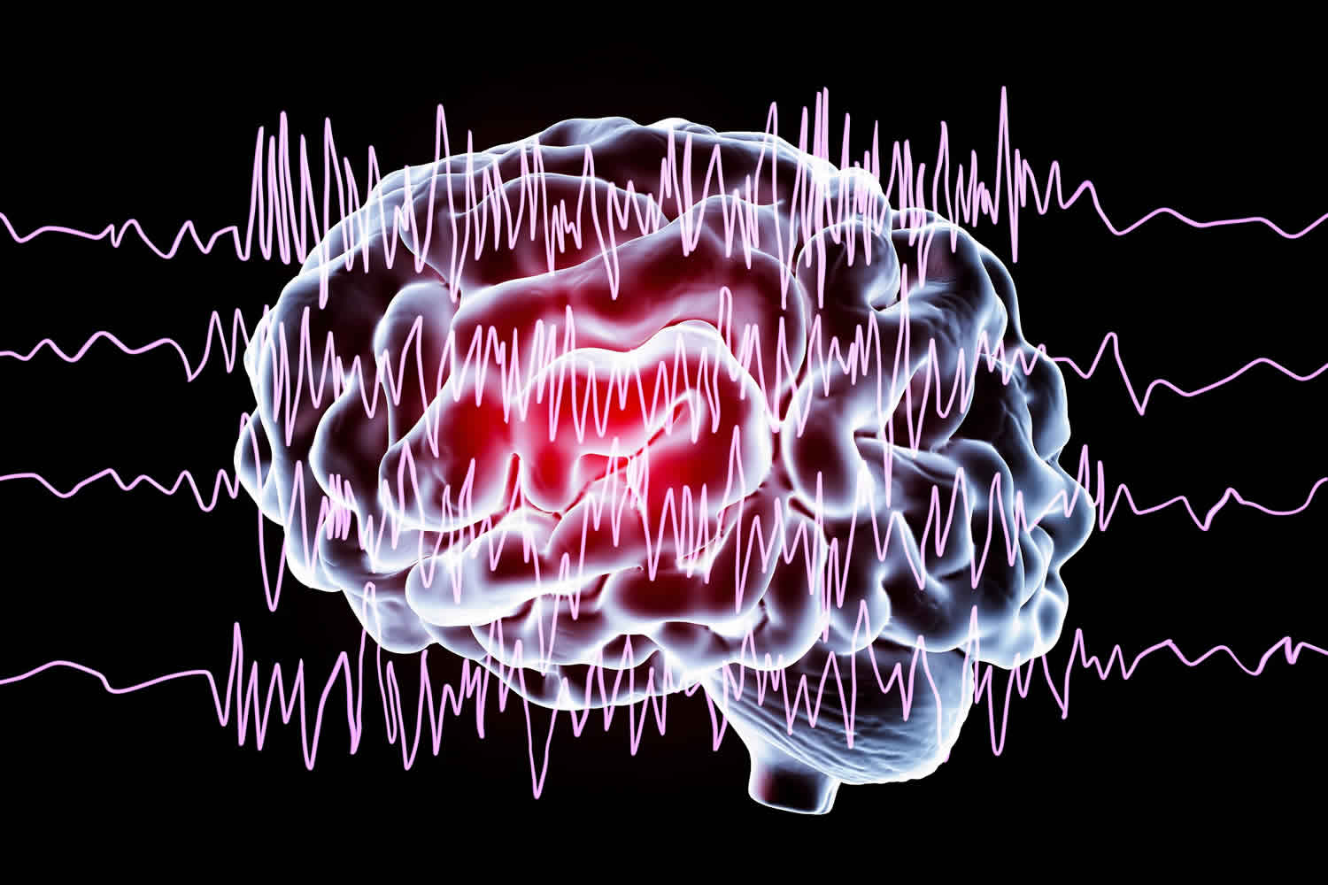 Reflex epilepsy causes, signs, symptoms, diagnosis, treatment & prognosis