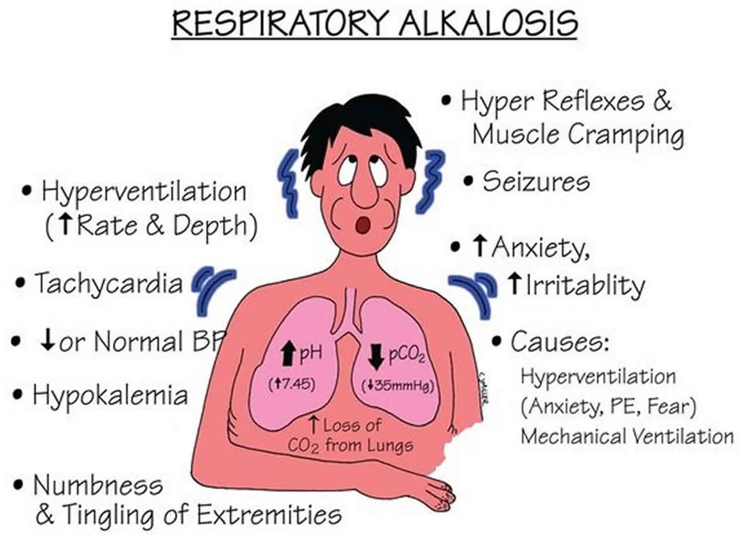 Respiratory Alkalosis Causes Symptoms Diagnosis Treatment Prognosis