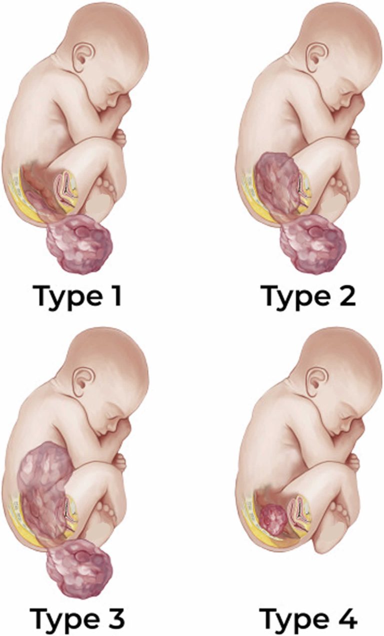 Sacrococcygeal Teratoma Types Cause Symptoms Diagnosis Treatment And Prognosed