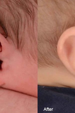 Stahl’s ear