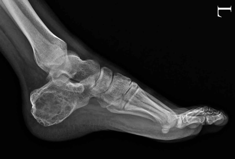 Aneurysmal bone cyst causes, symptoms, diagnosis, treatment, recurrence ...