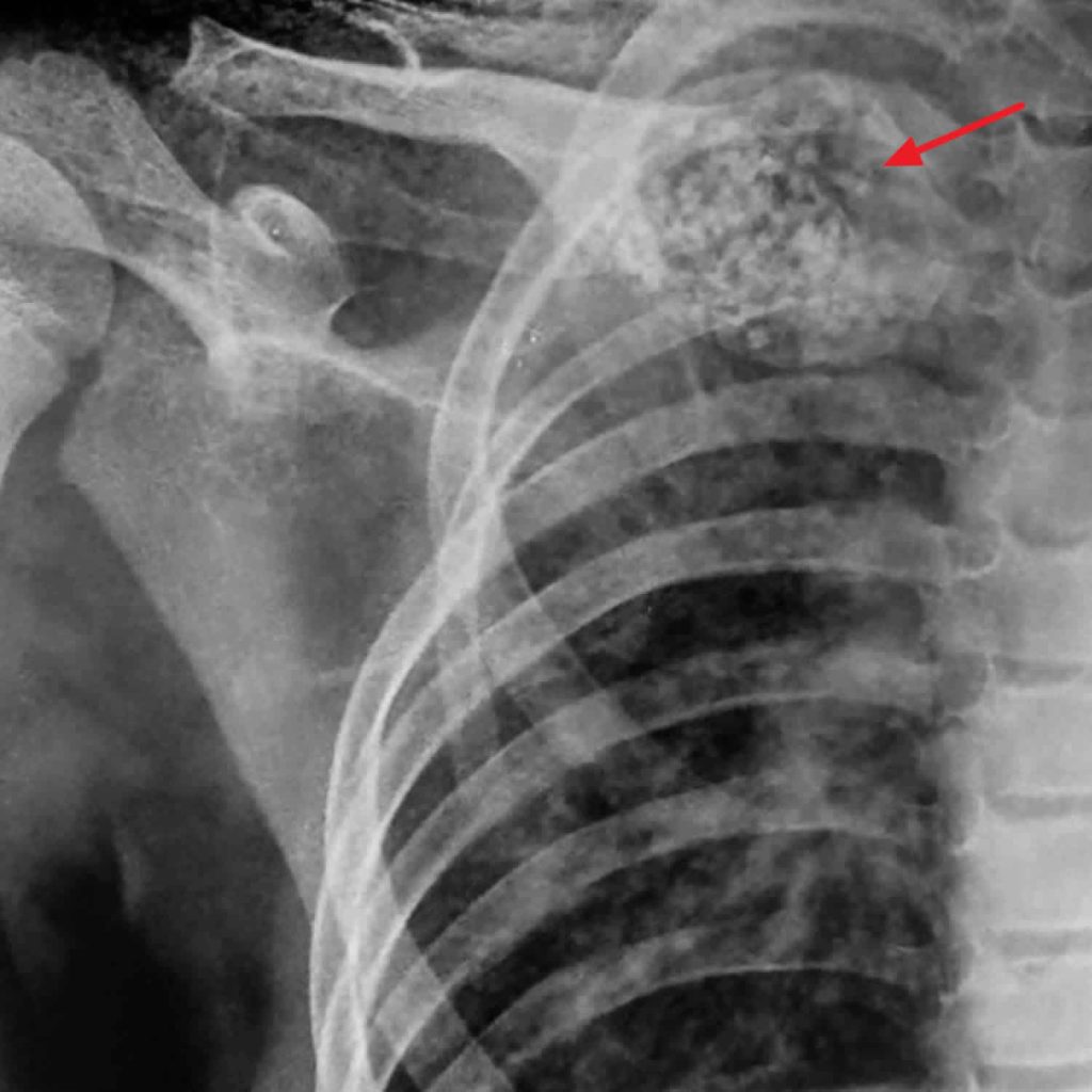 Aneurysmal bone cyst causes, symptoms, diagnosis, treatment, recurrence