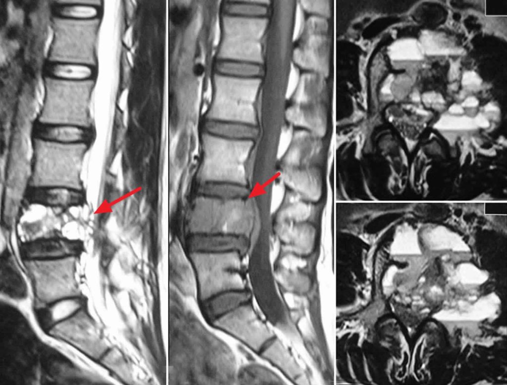 Aneurysmal Bone Cyst Causes Symptoms Diagnosis Treatment Recurrence And Prognosis 0349