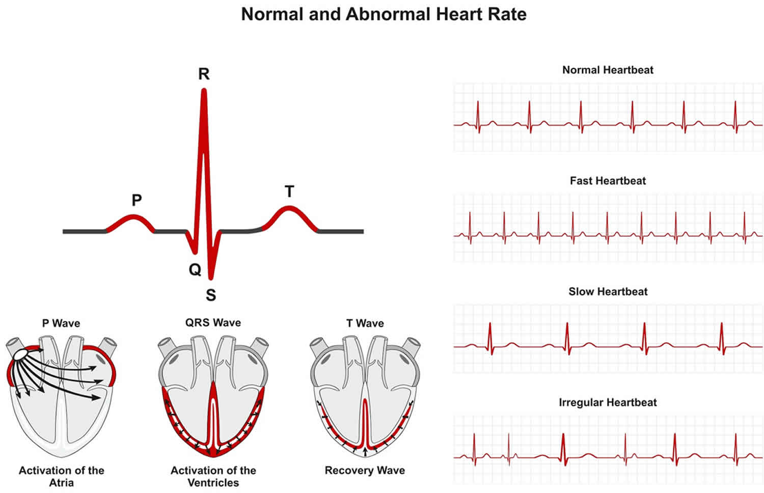 Arrhythmias Meaning Causes Symptoms Diagnosis Ecg Treatment