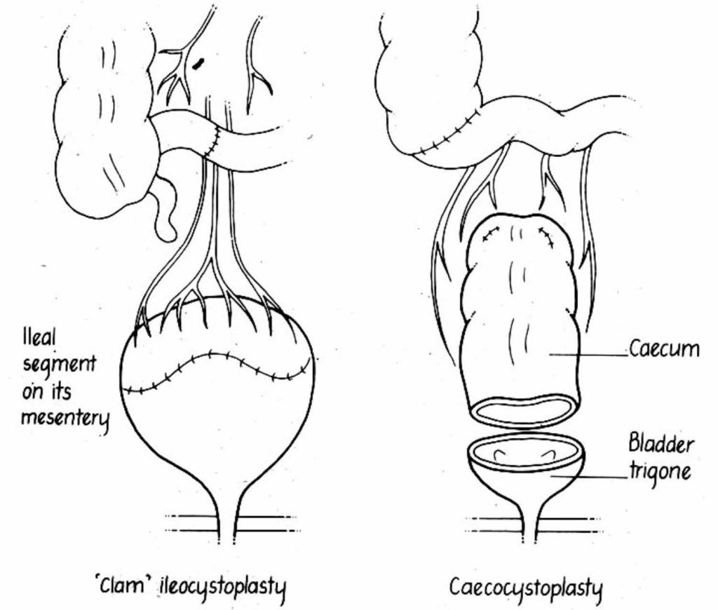 Bladder augmentation cystoplasty indications, complications, recovery ...