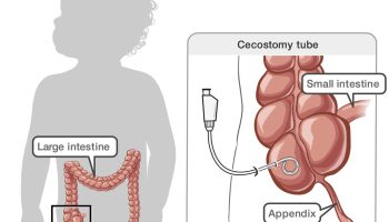 cecostomy-tube