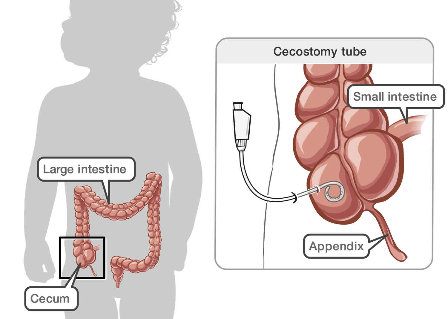 About Ostomies — Ostomy Halifax