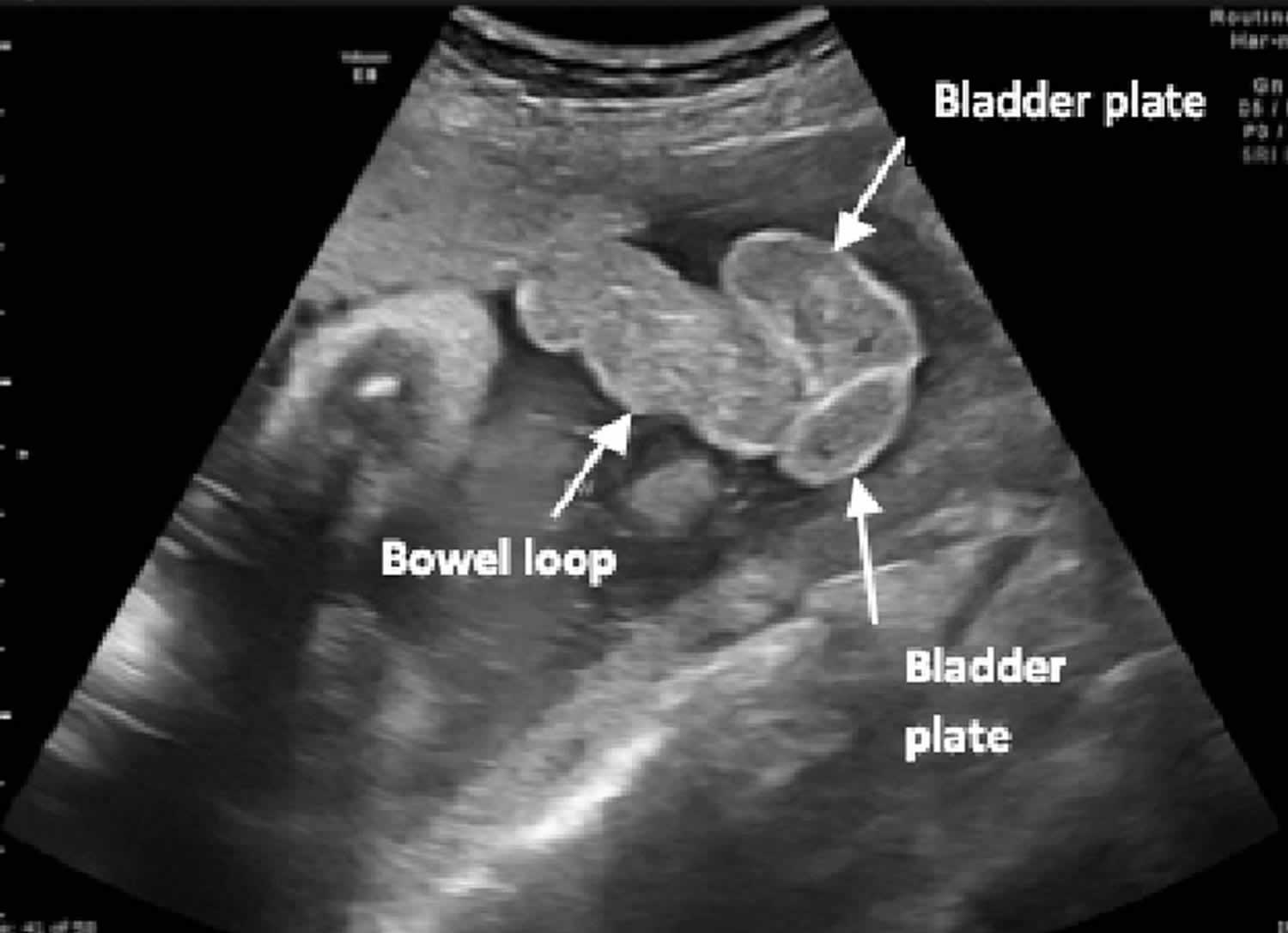 Cloacal exstrophy ultrasound