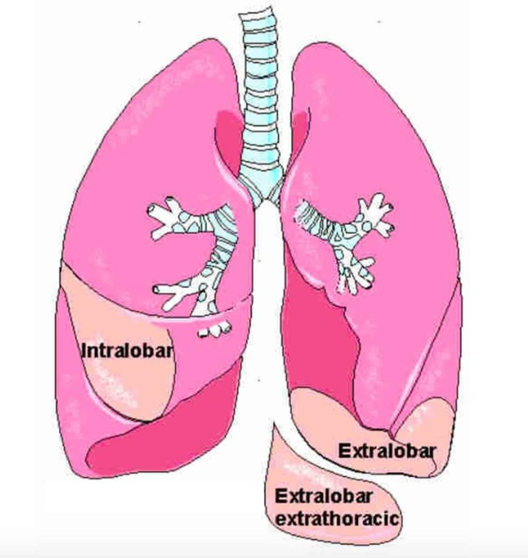 Bronchopulmonary sequestration causes, symptoms, diagnosis, treatment ...