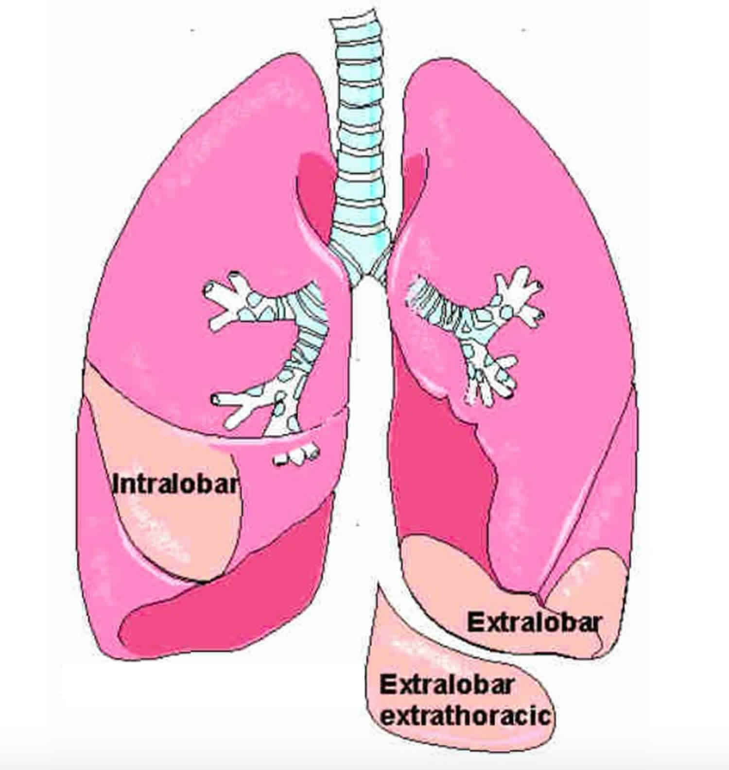 fetal pulmonary sequestration