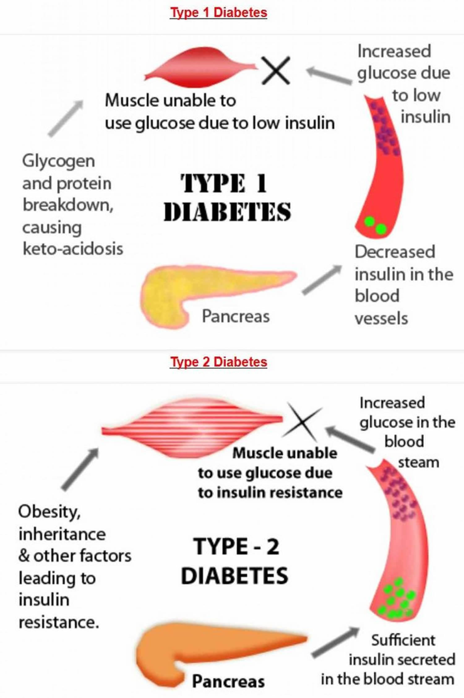 Type 1 and type 2 diabetes differences