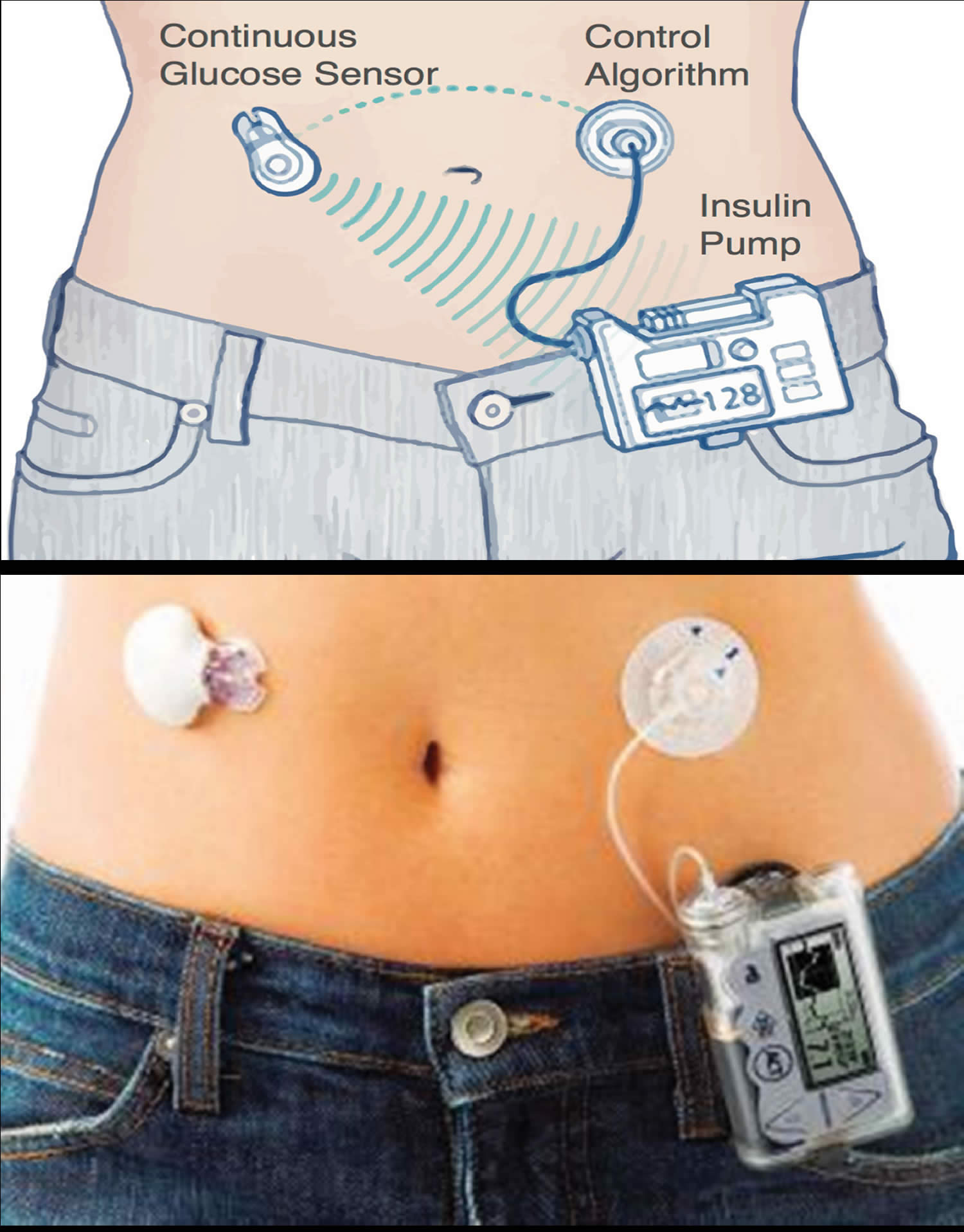 Insulin pump for type 1 diabetes