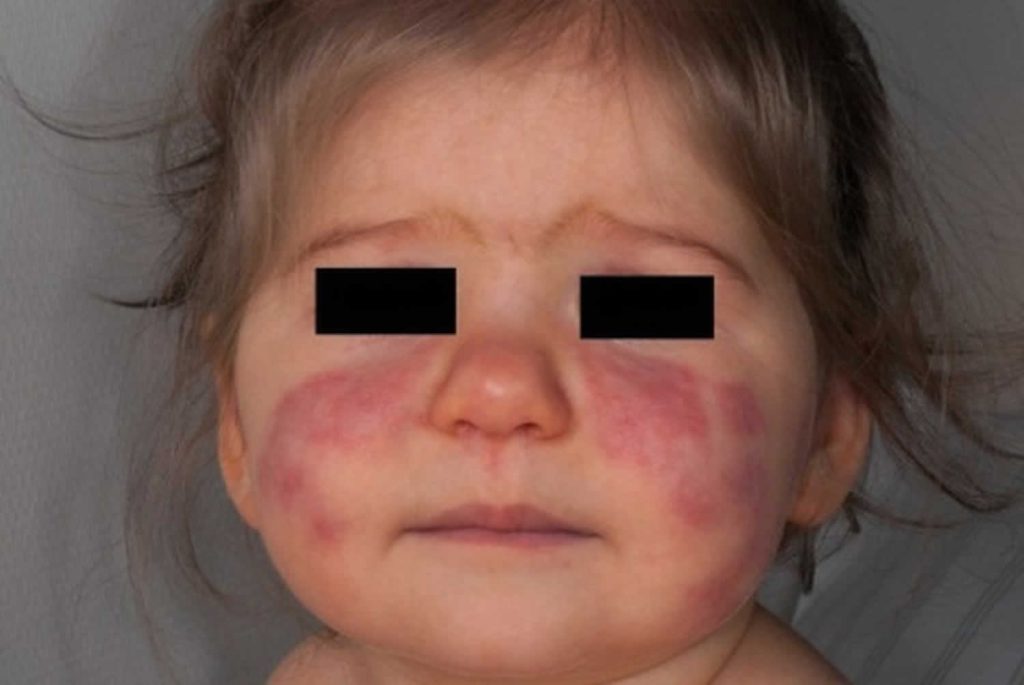 Pediatric Lupus Causes, Symptoms, Diagnosis, Treatment & Prognosis