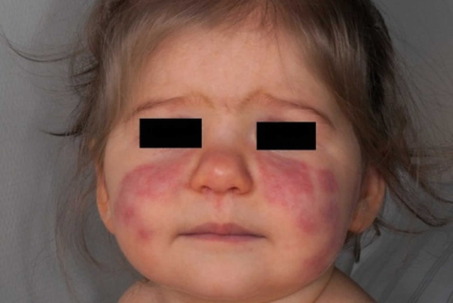 pediatric lupus rash