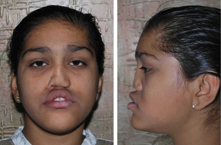 Binder syndrome causes, symptoms, diagnosis, treatment & prognosis