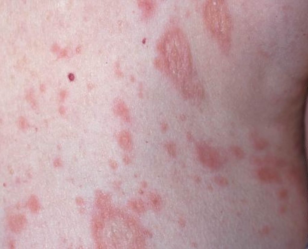 Pityriasis rosea in children causes, symptoms, diagnosis & treatment