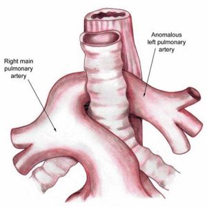 Vascular ring causes, symptoms, diagnosis, treatment & prognosis