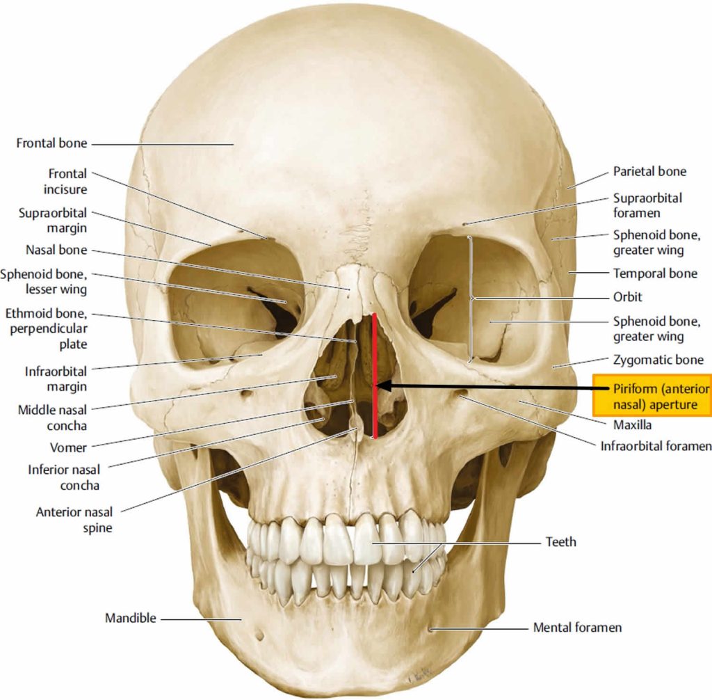 Congenital pyriform aperture stenosis causes, symptoms, diagnosis ...