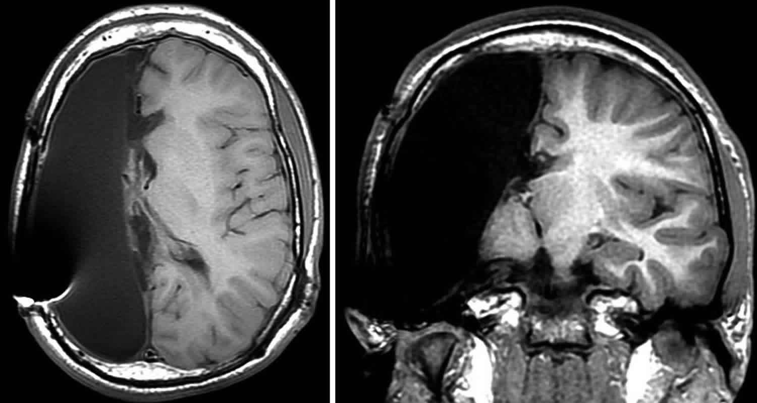 Hemispherectomy indications, prognosis, risks, side effects & complications