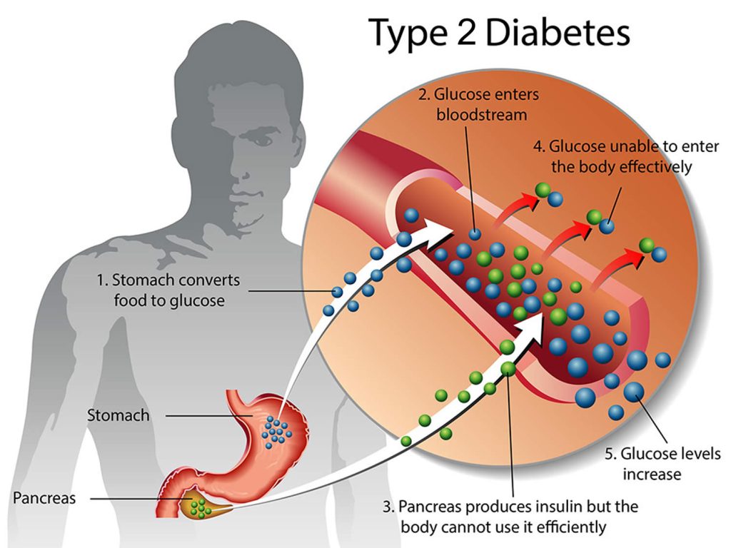 Type 2 diabetes, causes, symptoms, complications, diagnosis & treatment