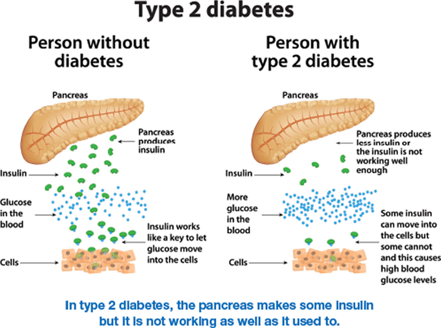 Type 2 Diabetes Causes Symptoms Complications Diagnosis Treatment