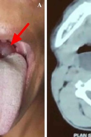 vallecular-cyst