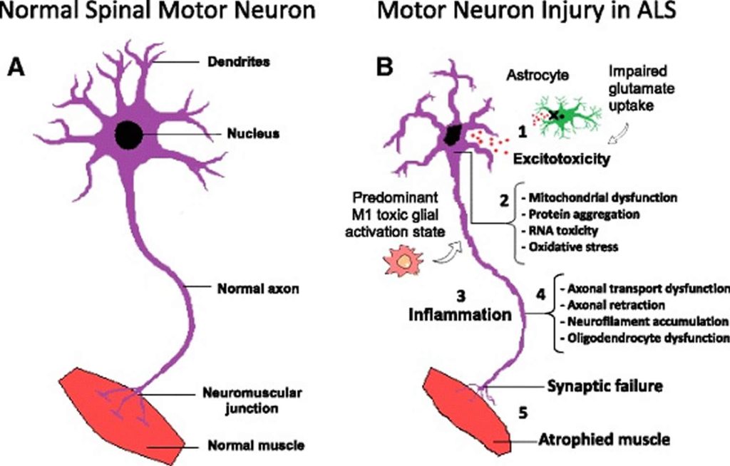 Amyotrophic Lateral Sclerosis Causes Symptoms Diagnosis Treatment Prognosis