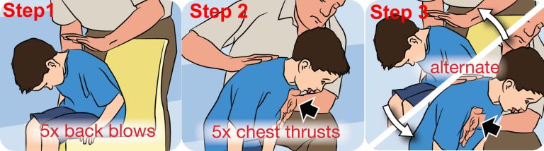 Heimlich Maneuver For Choking Baby, Infants And Children