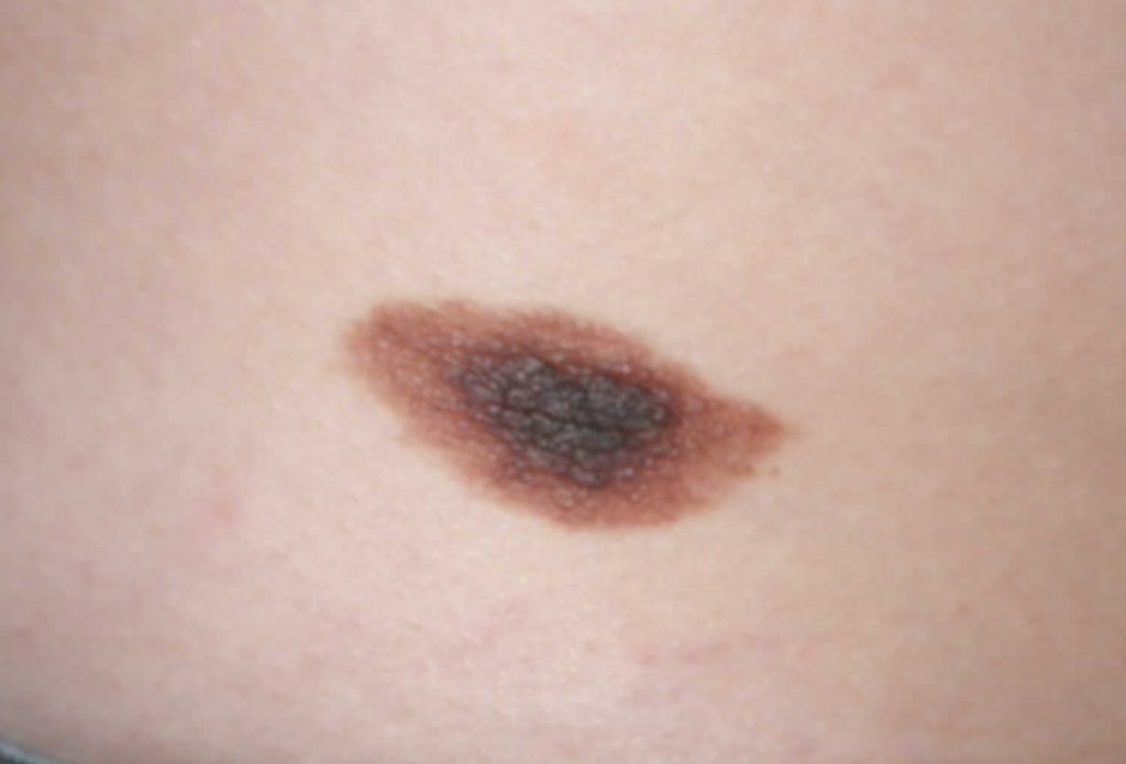 Congenital nevus & congenital melanocytic nevus causes, symptoms ...