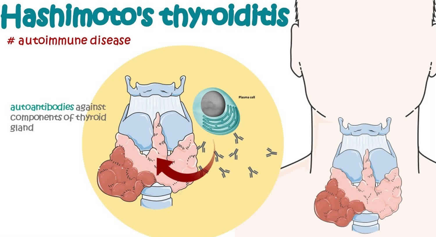 Hashimoto Disease Causes Symptoms Diagnosis Treatment